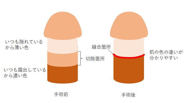 環状切開術