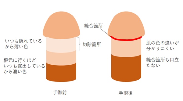 亀頭直下埋没法